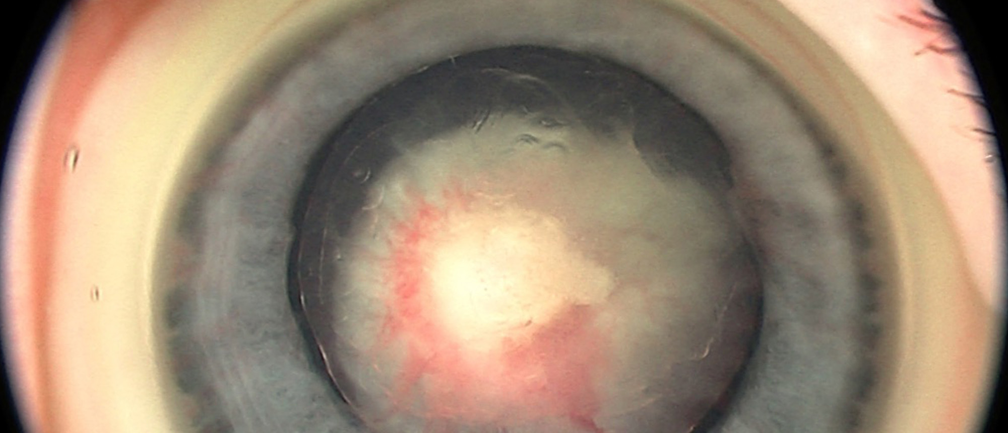 Persistent Fetal Vasculature