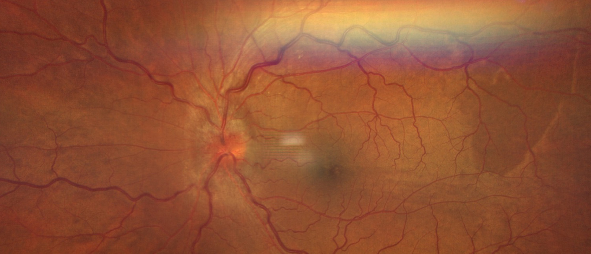 Thyroid Associated Ophthalmopathy with Compressive Optic Neuropathy