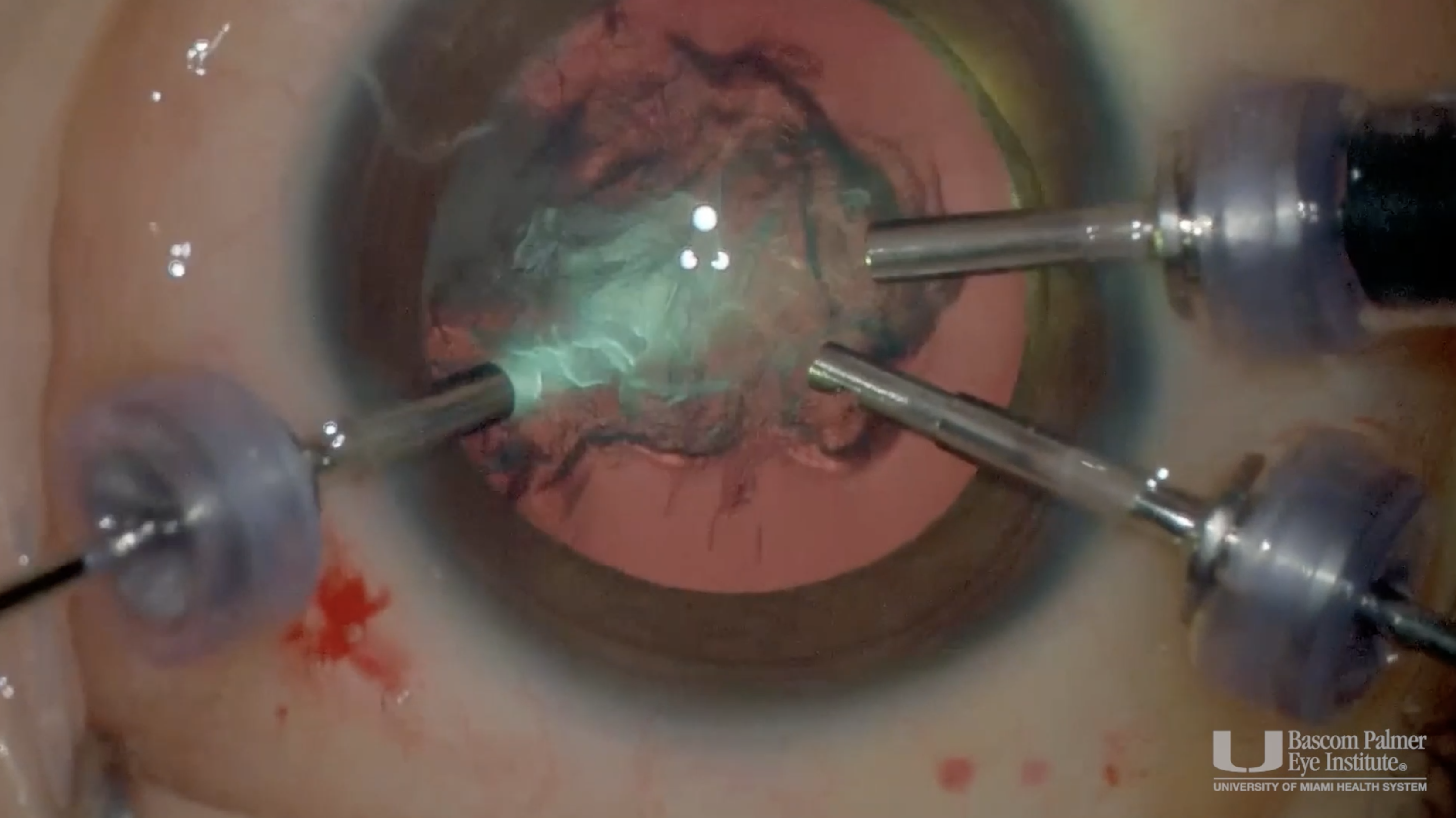 Surgery for Persistent Fetal Vasculature