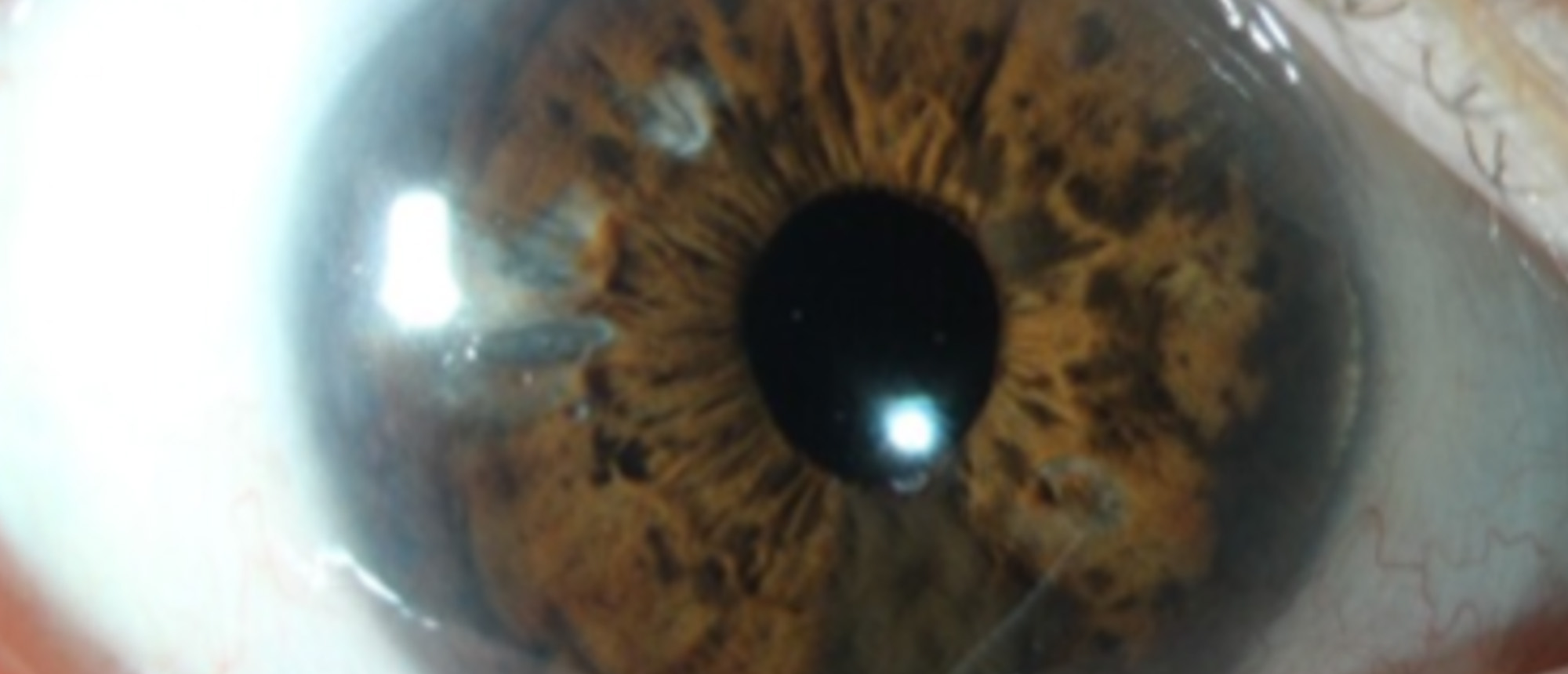 Diffuse Iris Melanoma