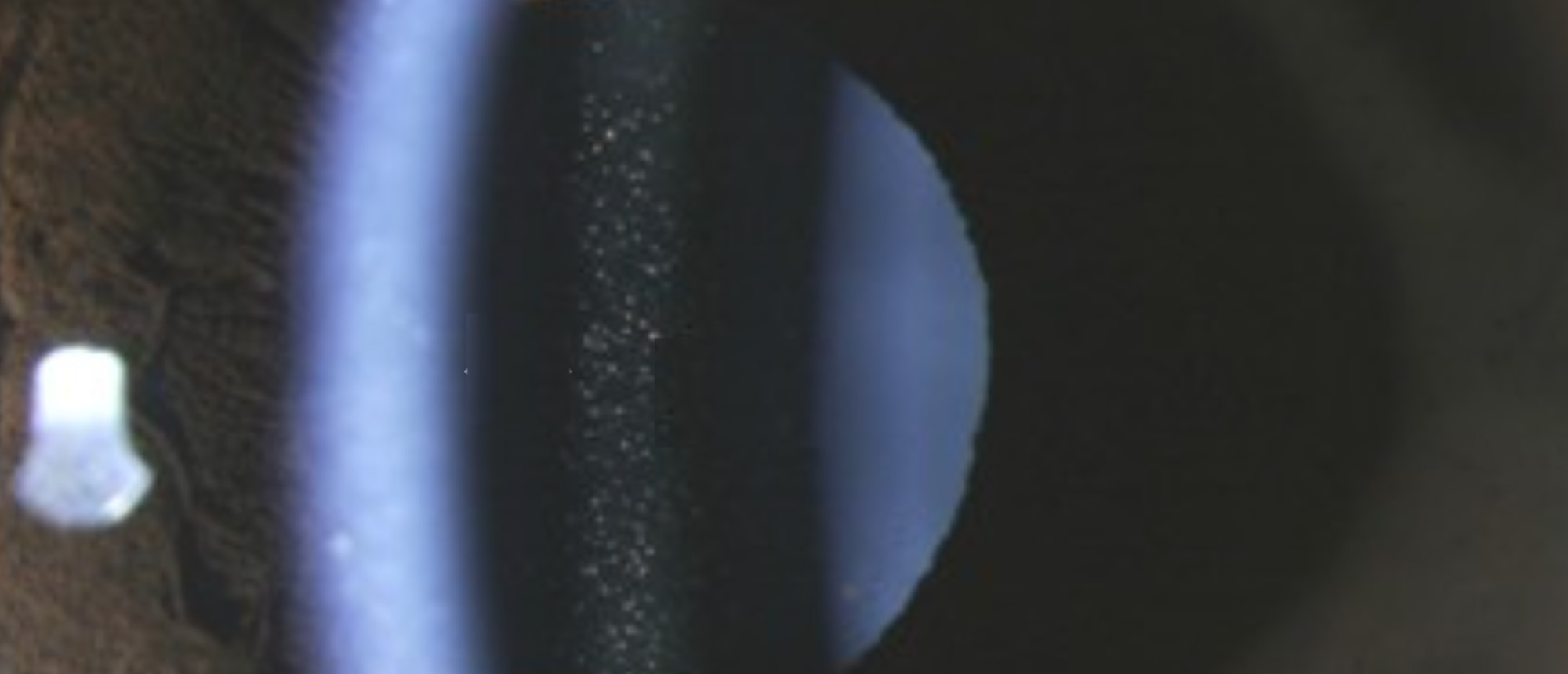 Elevated Intraocular Pressure After Phakic Posterior Chamber Intraocular Lens Placement