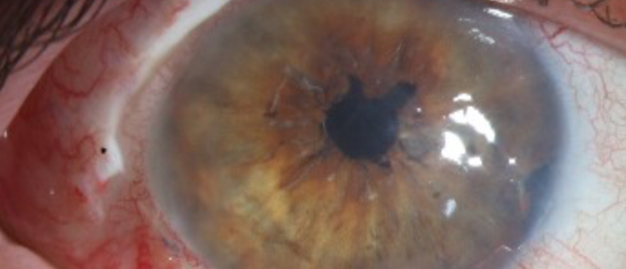 Traumatic Iris Tear