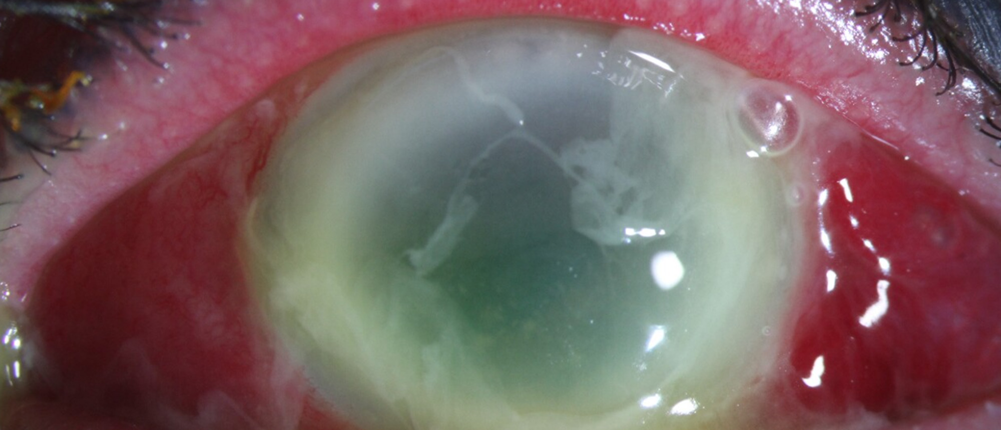 Endophthalmitis in the Setting of a XEN Stent