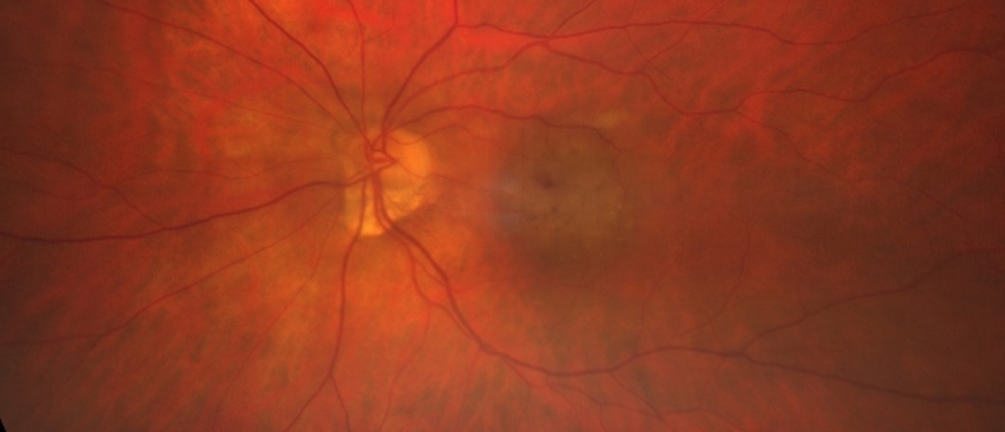 Type 3 Macular Neovascularization/Retinal Angiomatous Proliferation