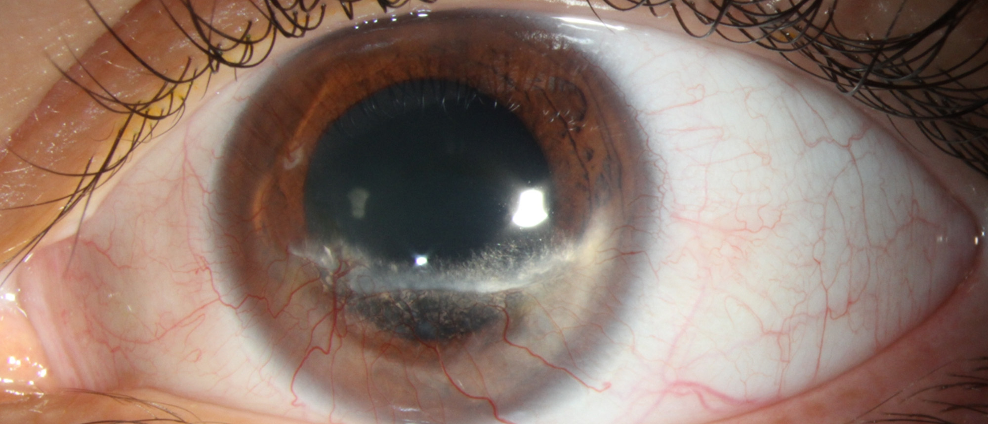 Terrien Marginal Degeneration