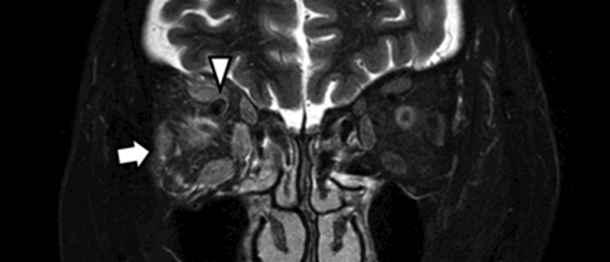 Type C Carotid Cavernous Fistula