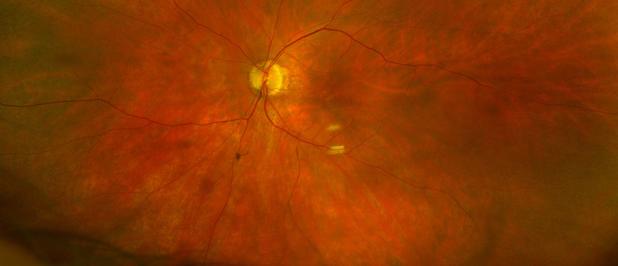 Non-Paraneoplastic Autoimmune Retinopathy (npAIR)