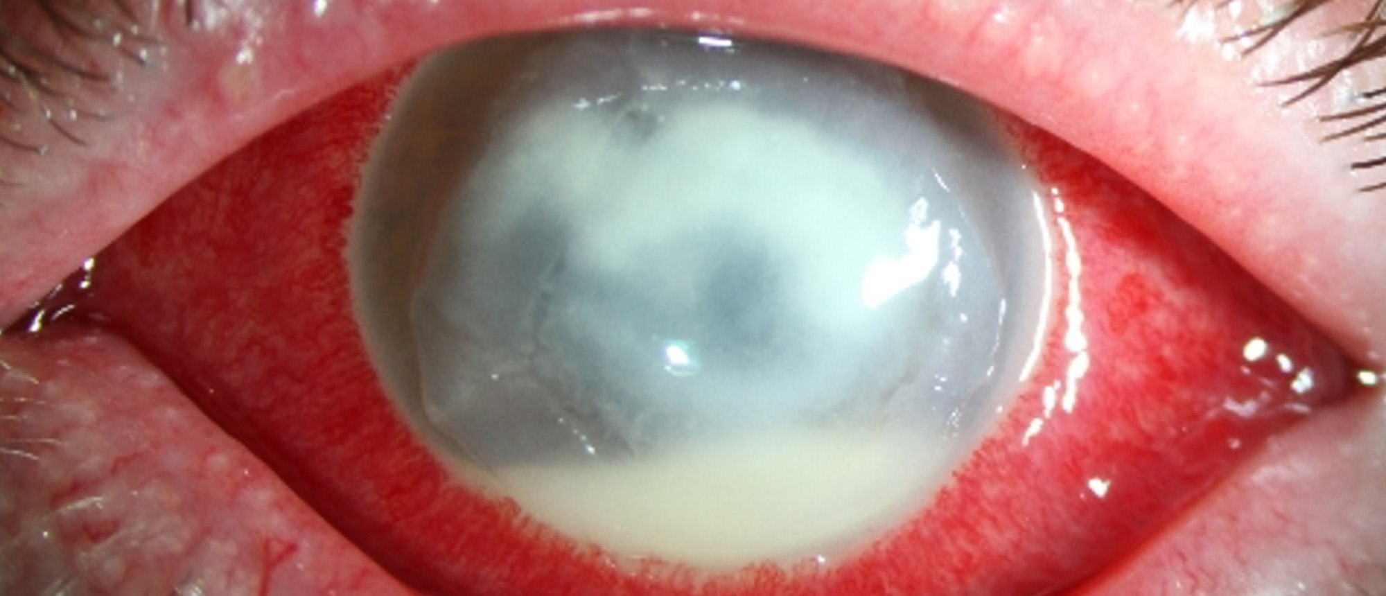 Multi-Drug Resistant Pseudomonas Keratitis