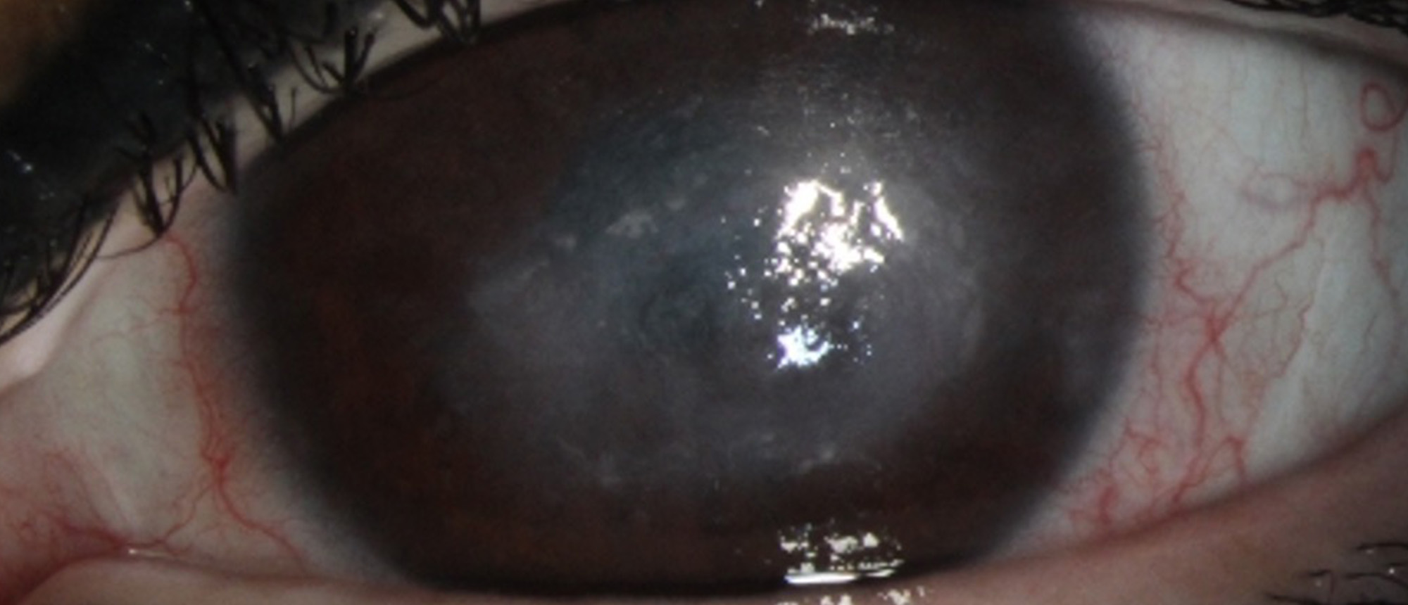 Neurotrophic Keratitis