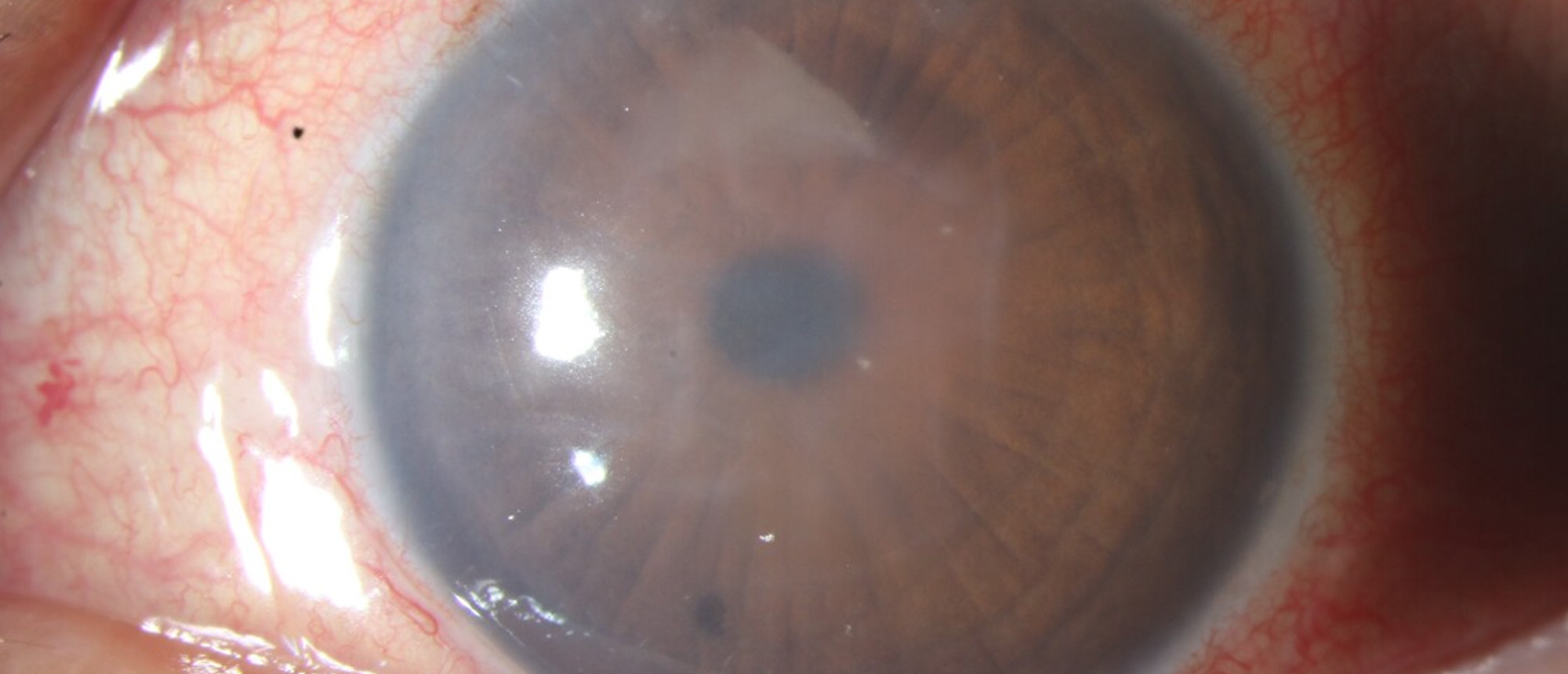 Fuchs Endothelial Dystrophy