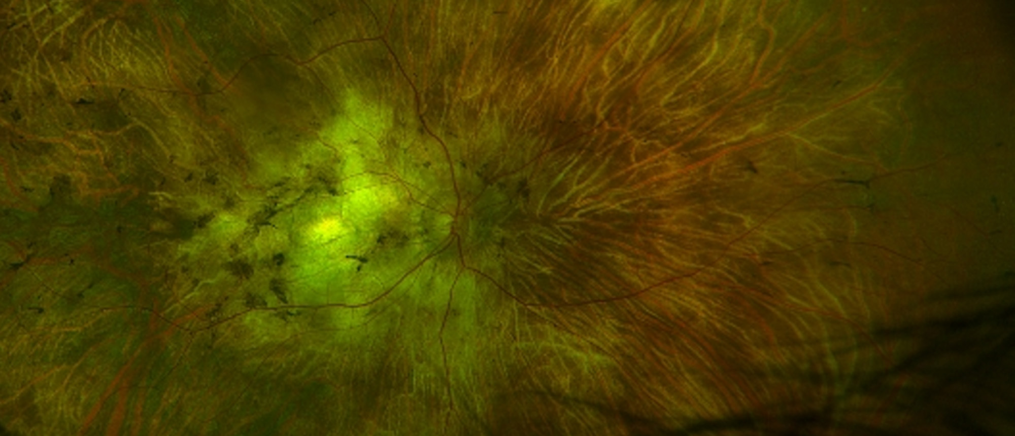 ABCA-4 Retinal Dystrophy