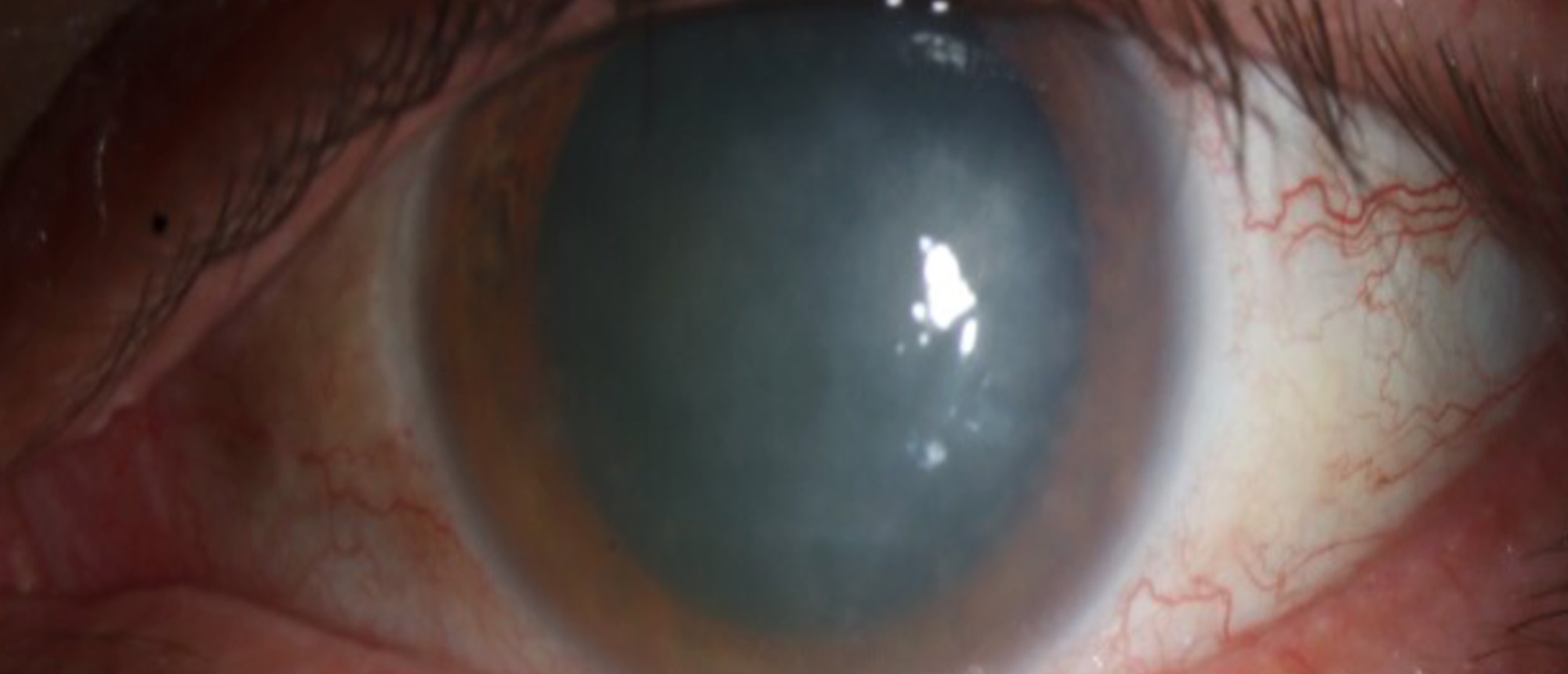 Microsporidial Keratitis