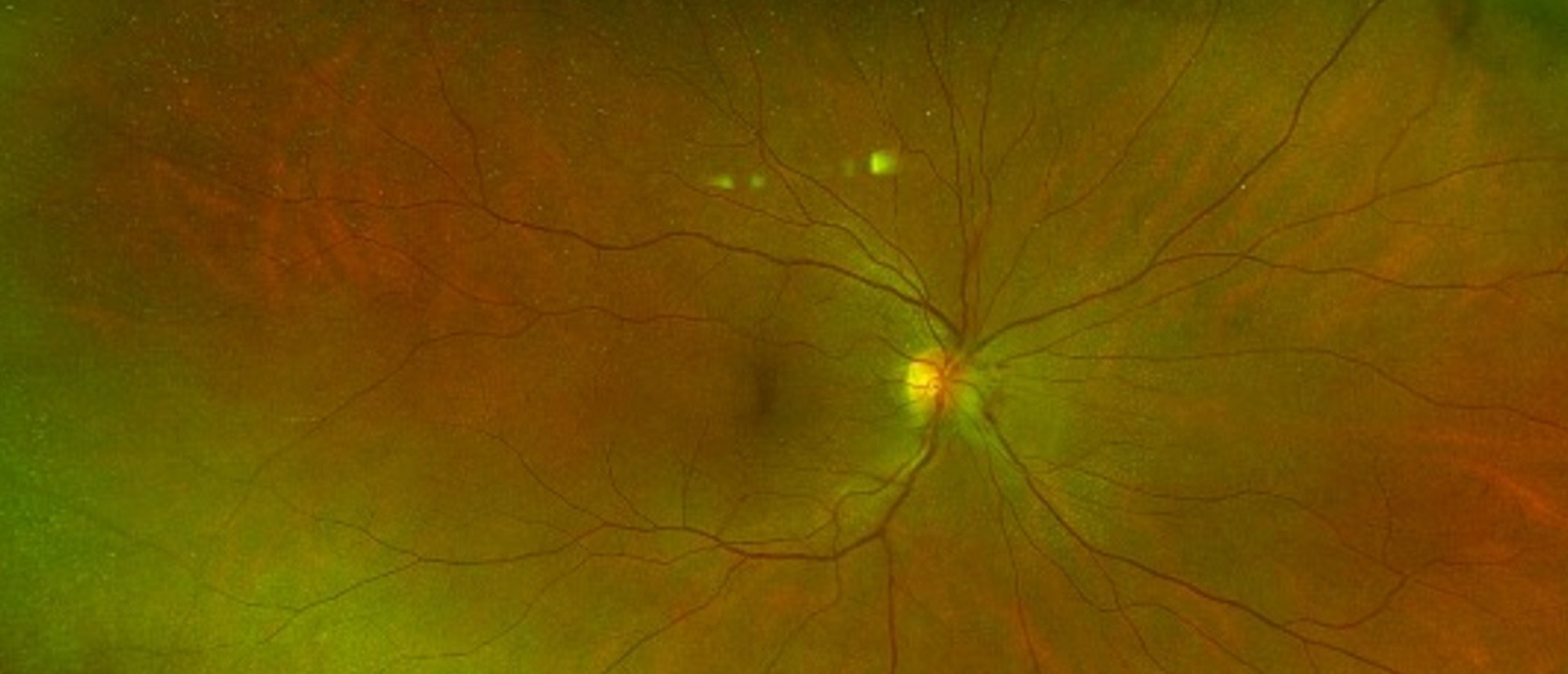 Bartonella Neuroretinitis