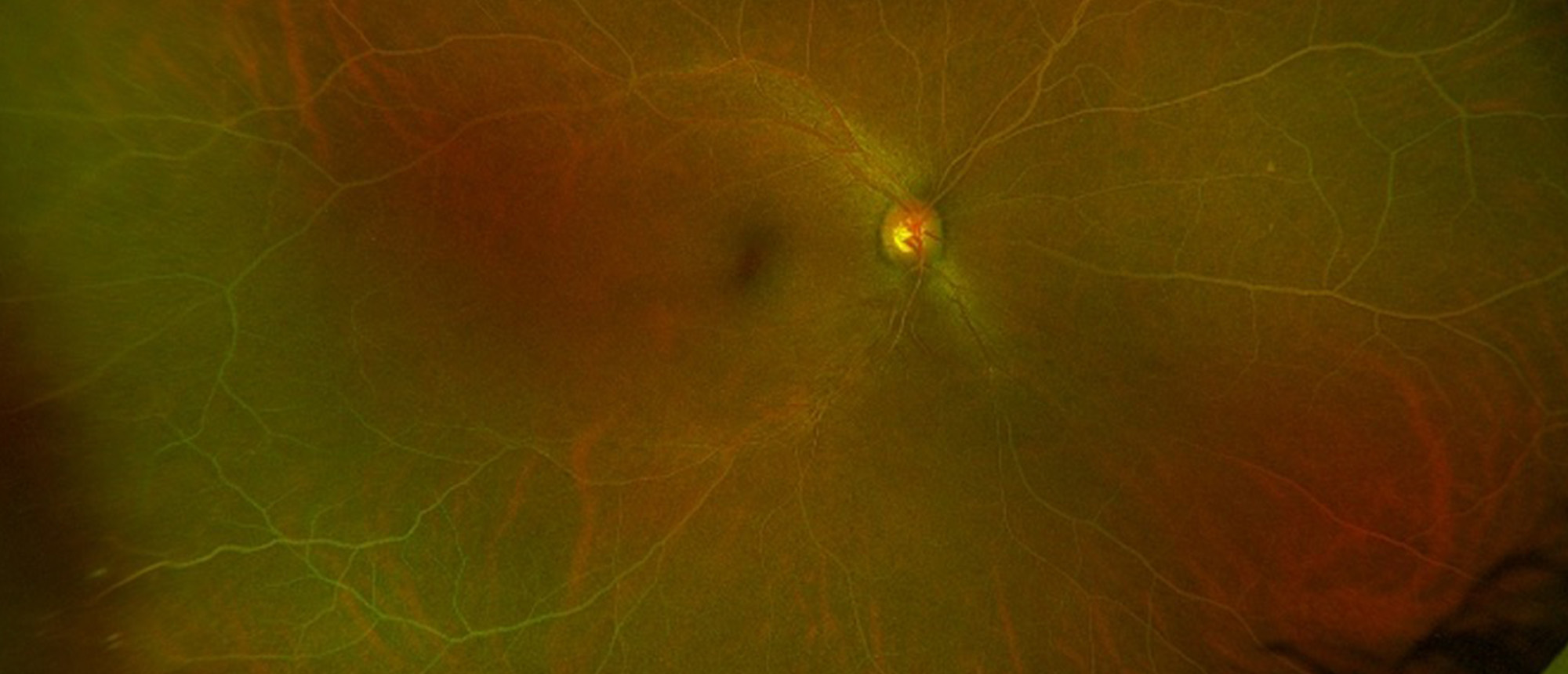 Lipemia Retinalis