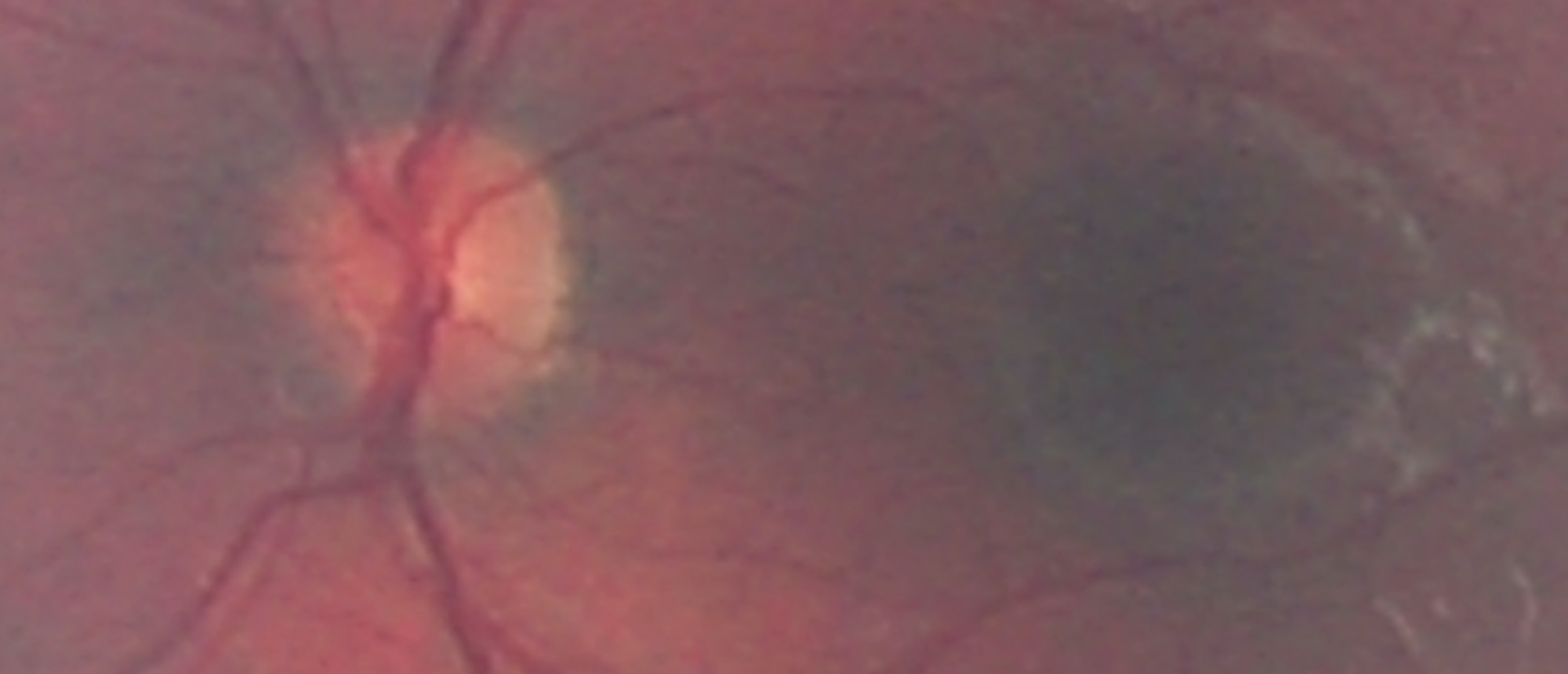 Primary Congenital Glaucoma