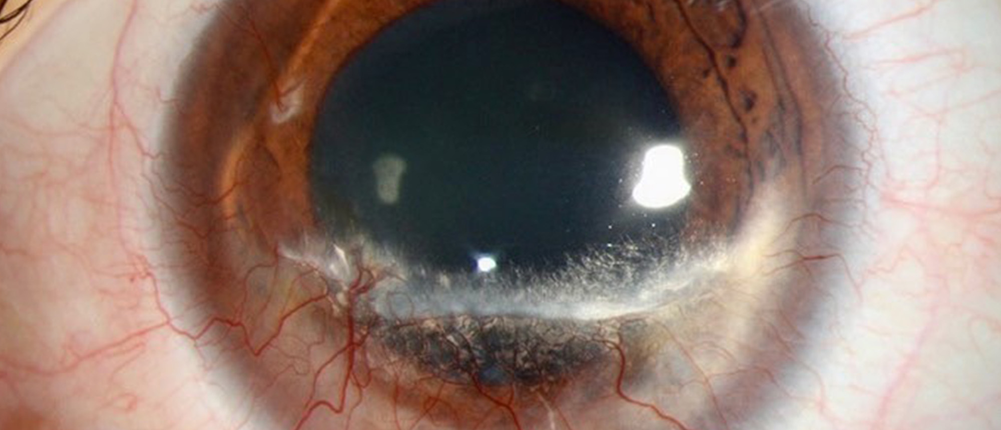 Terrien Marginal Degeneration (TMD)