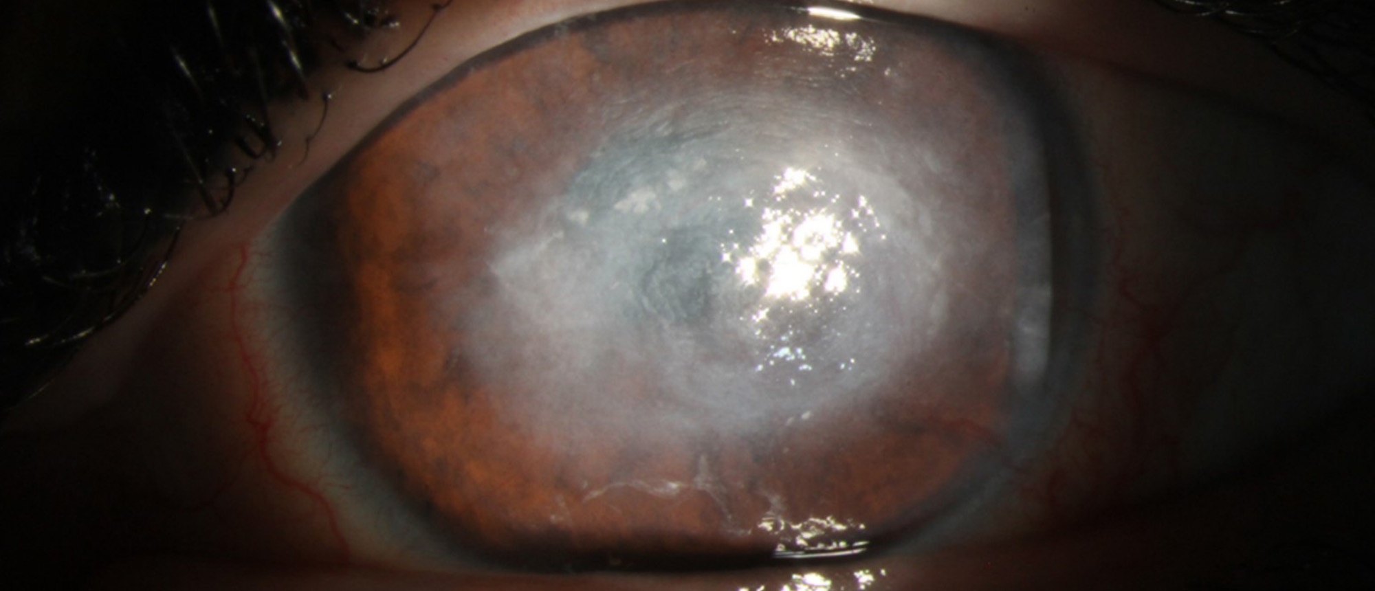 Corneal Neurotization