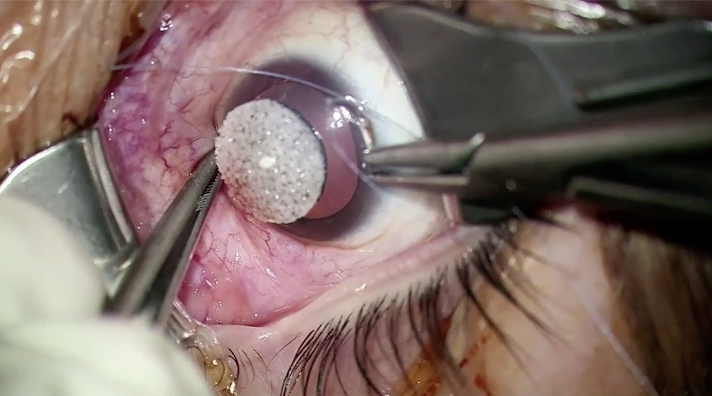 Nanophthalmos Surgery