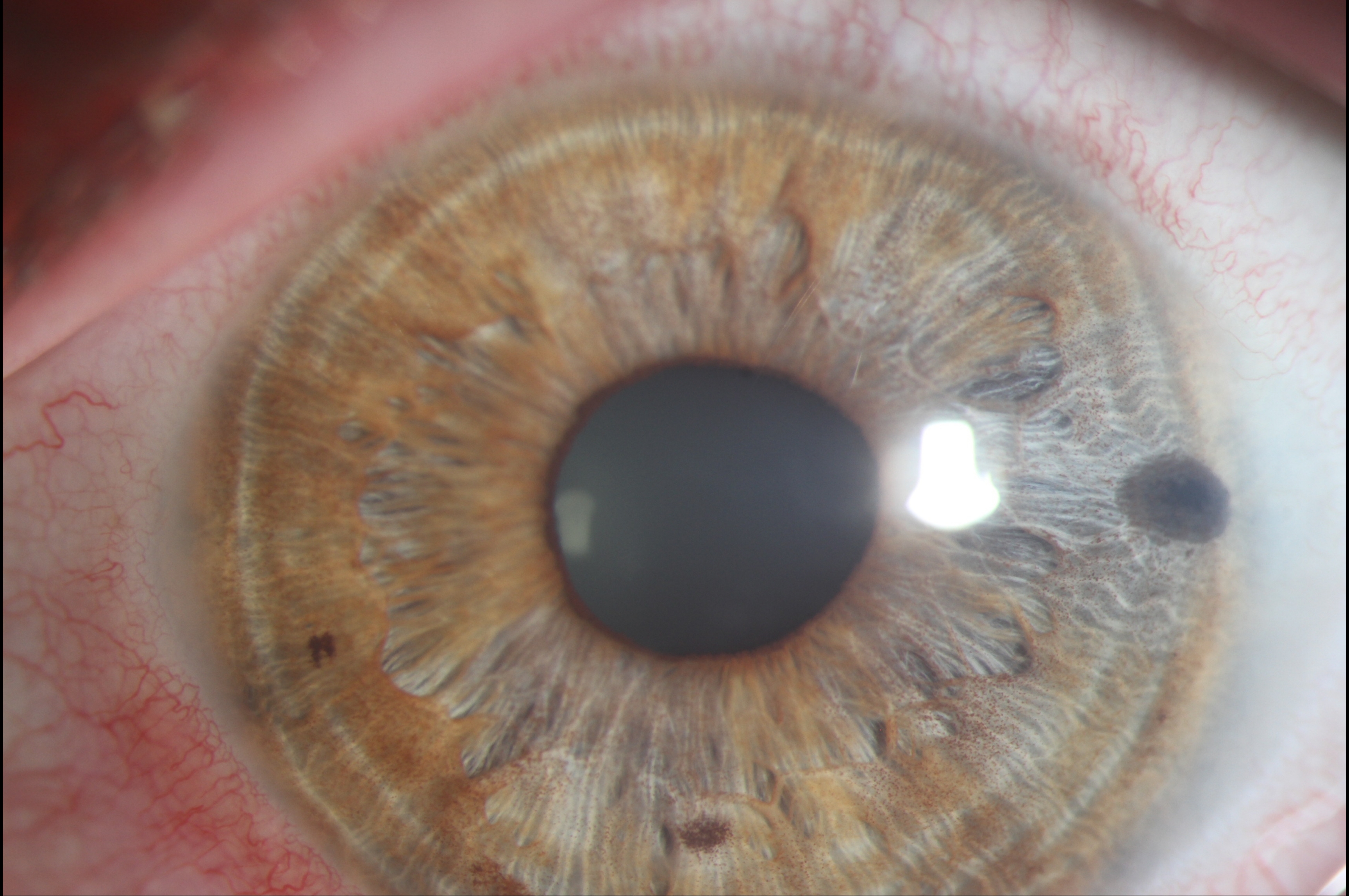 Peripheral Iridotomy