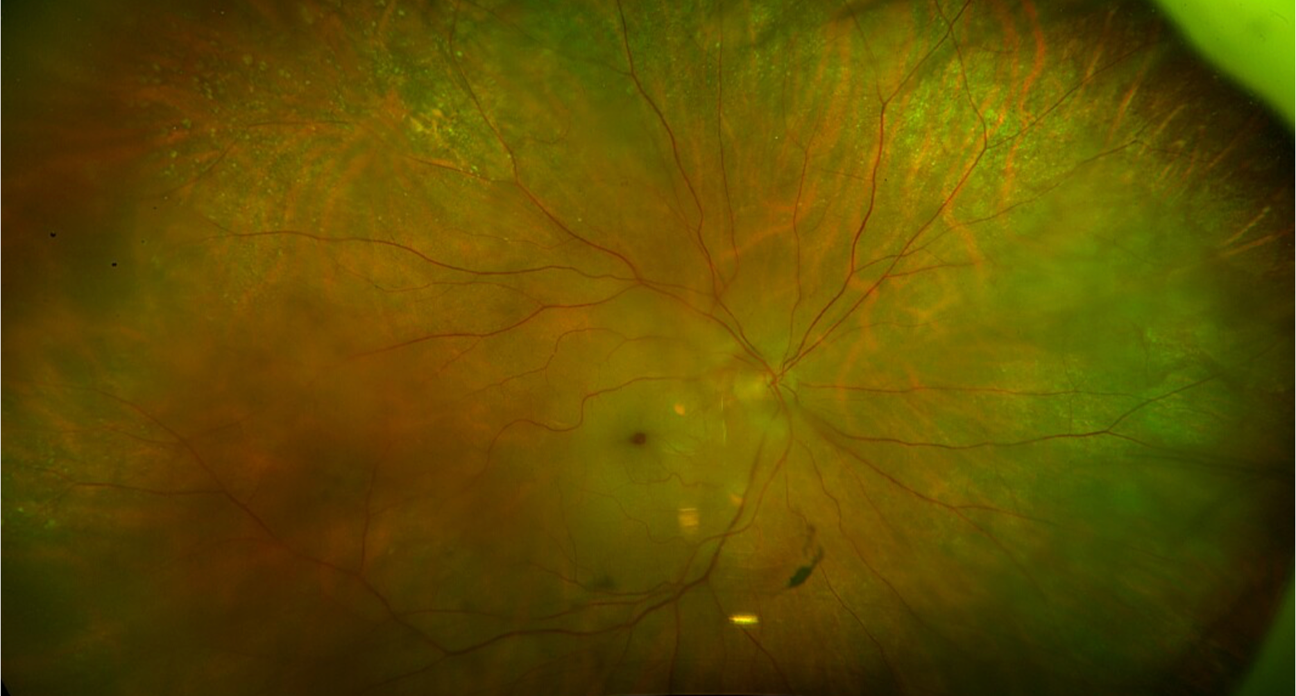 Central Retinal Artery Occlusion (CRAO)