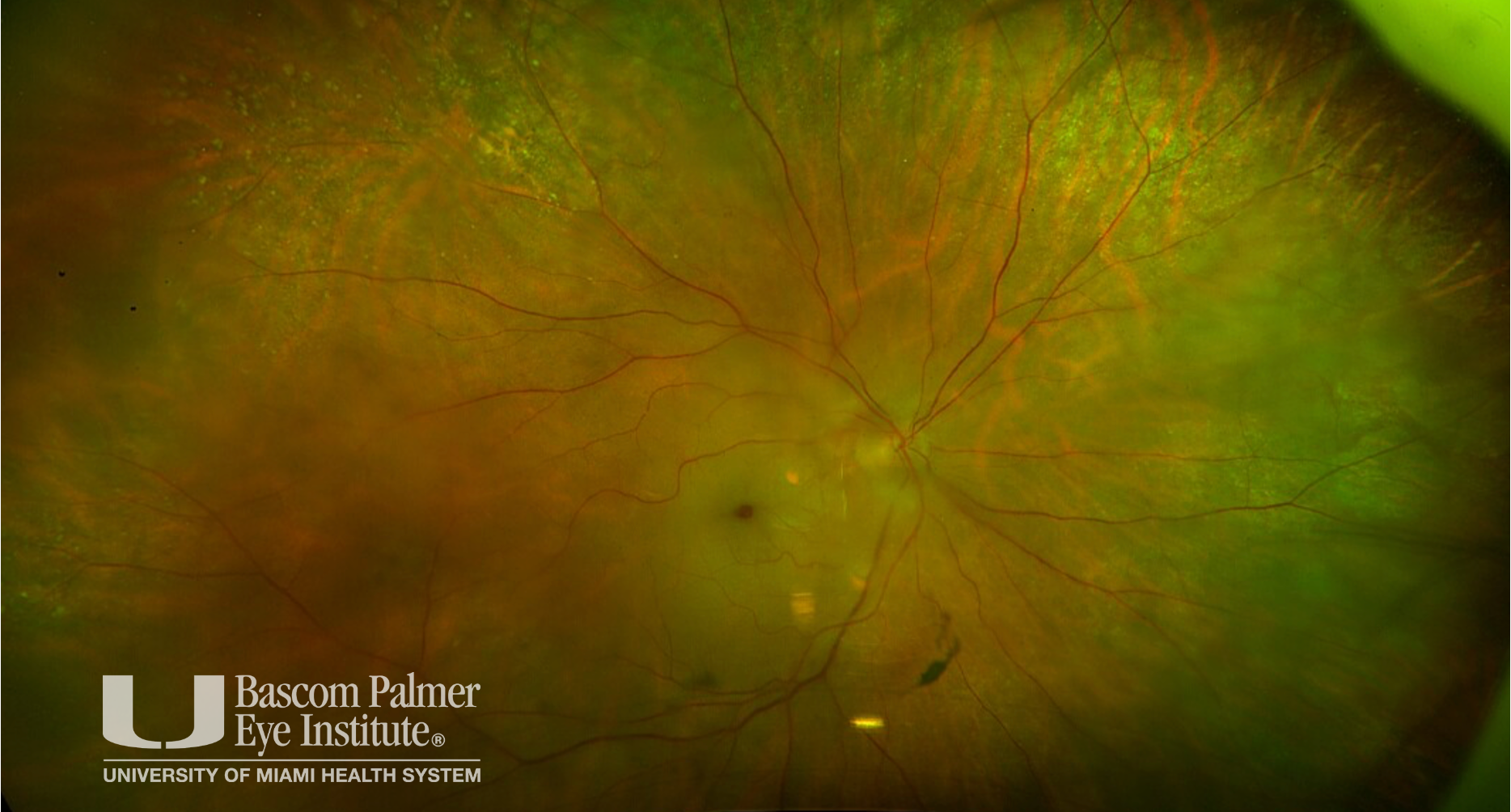 Central Retinal Artery Occlusion (CRAO)