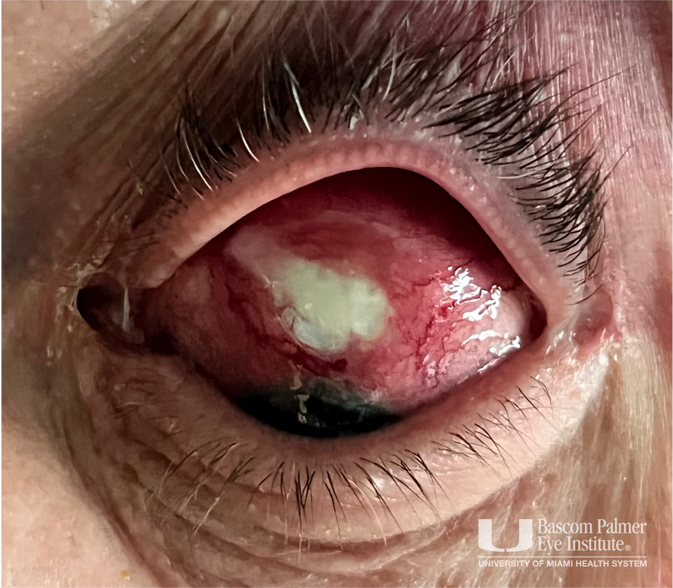 Non-Infectious Necrotizing Scleritis