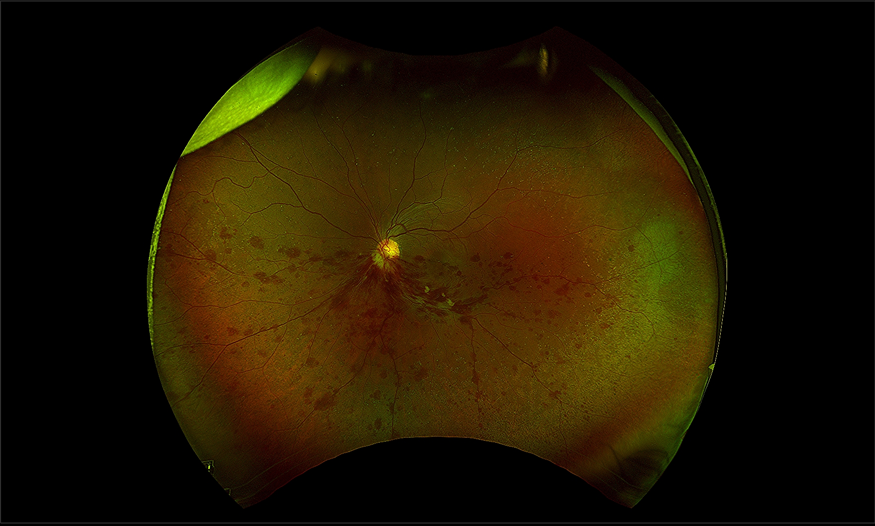 Caffeine-Associated Hemi-Retinal Vein Occlusion of the Left Eye secondary Cystoid Macular Edema