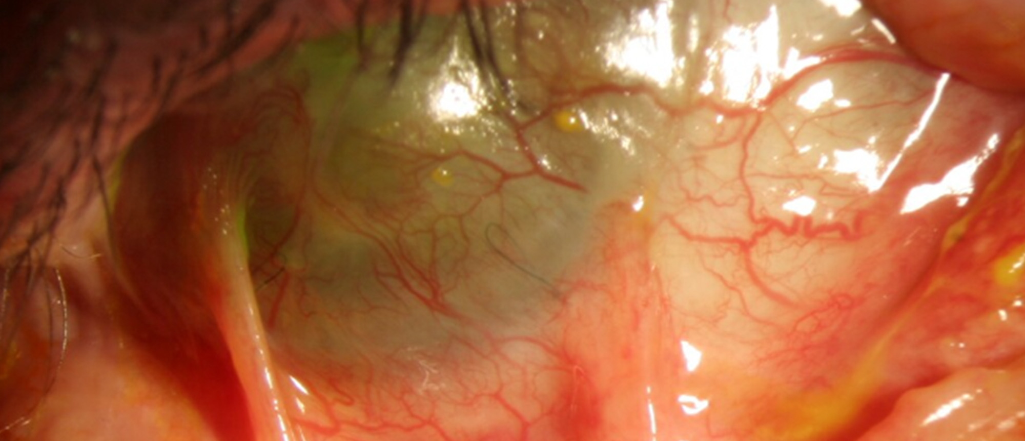 Ocular Cicatricial Pemphigoid