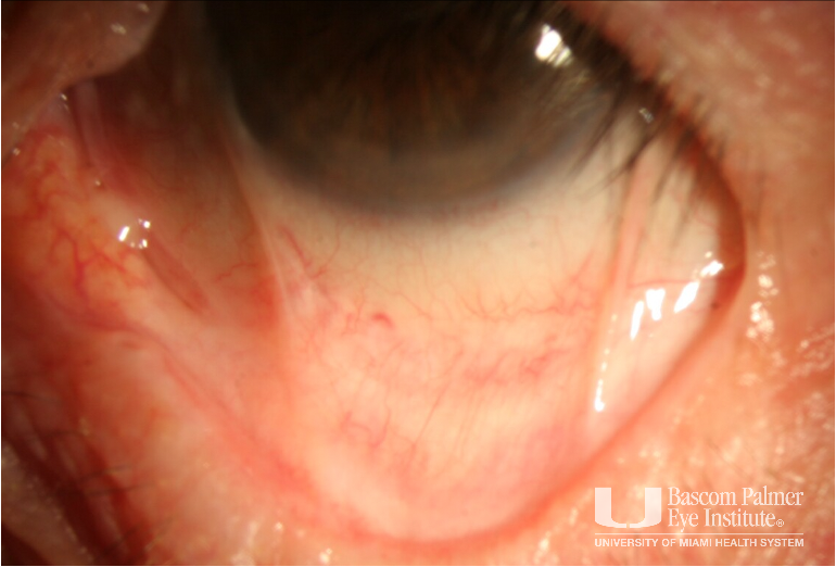 Ocular cicatricial pemphigoid with symblepharon in both eyes