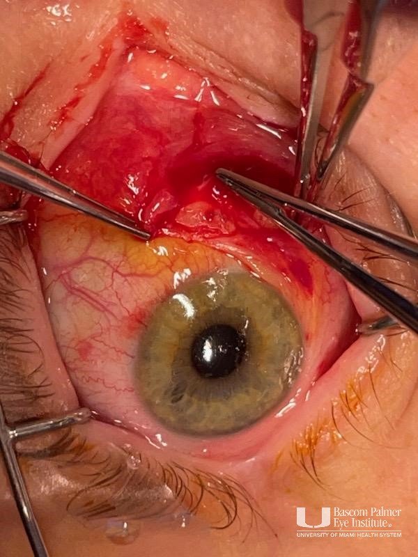 A patient with slipped right medial rectus 5 days after recession of medial rectus muscle in both eyes, intraoperative images