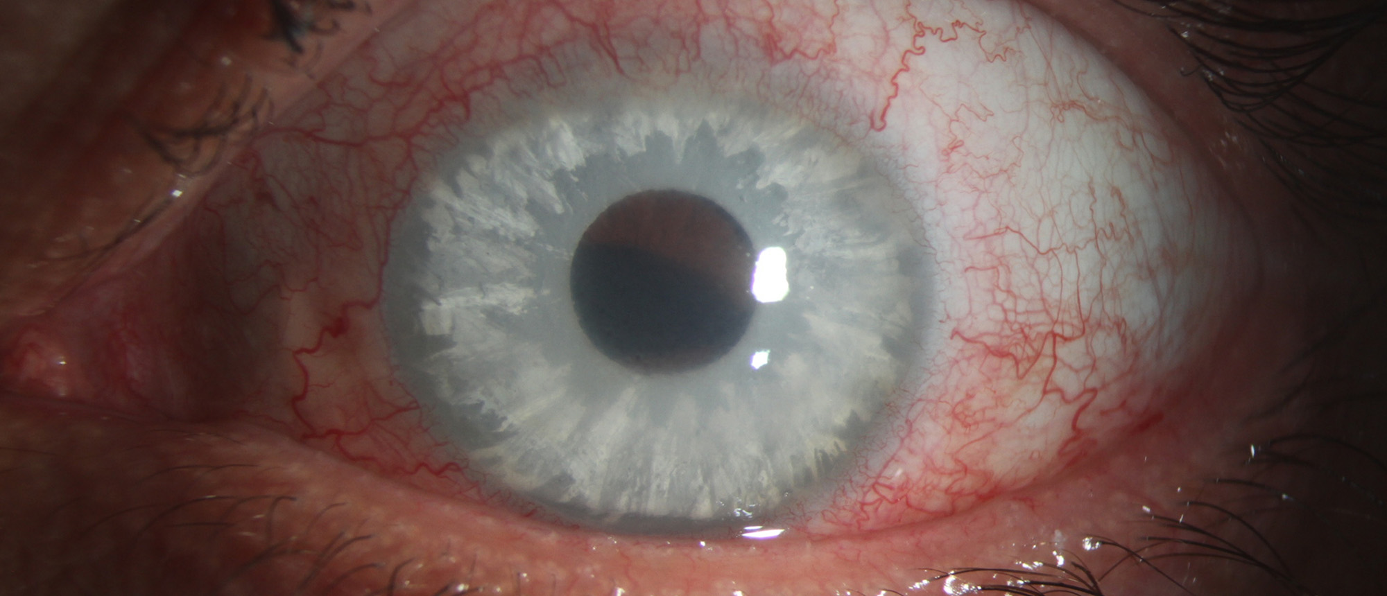 Corneal Decompensation Due to Cosmetic Iris Implants