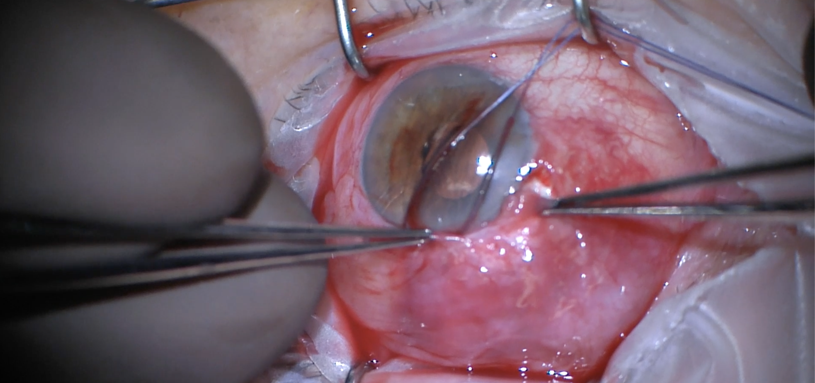 Trabeculectomy, Tube Ligation, and Excision of Fibrotic Capsule for Diplopia after Glaucoma Drainage Implant