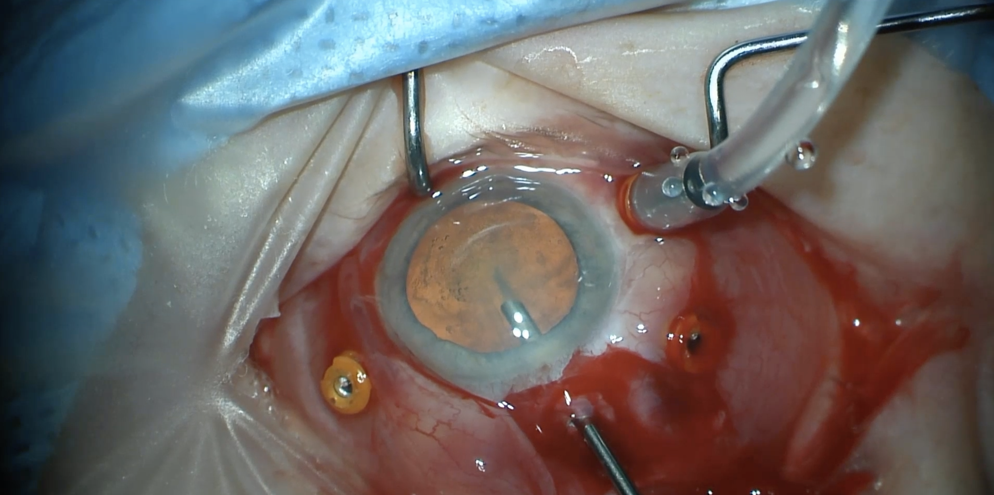 Phacomorphic Glaucoma