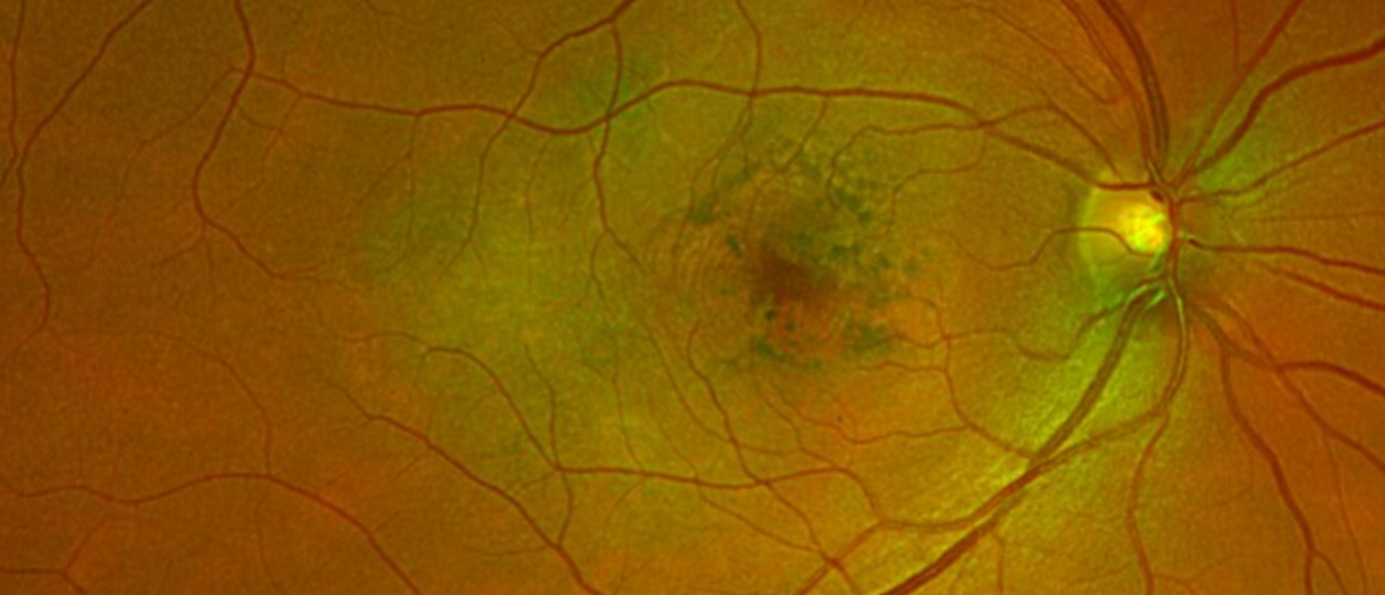 Fondaparinux Maculopathy
