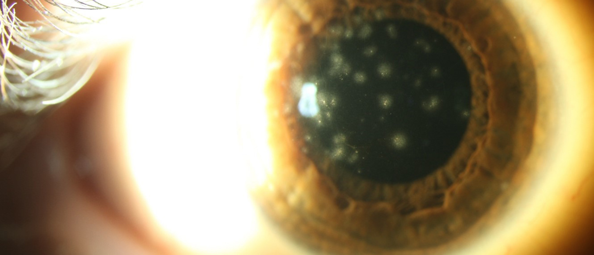 Recurrent Subepithelial Infiltrates Following Epidemic Keratoconjunctivitis