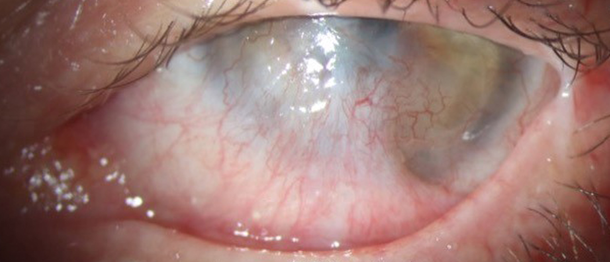 Ocular Surface Reconstruction