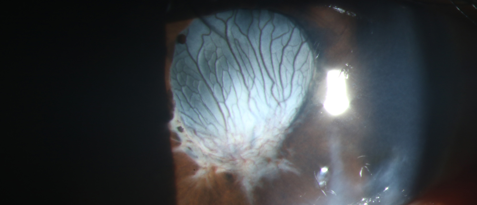 Epithelial Downgrowth