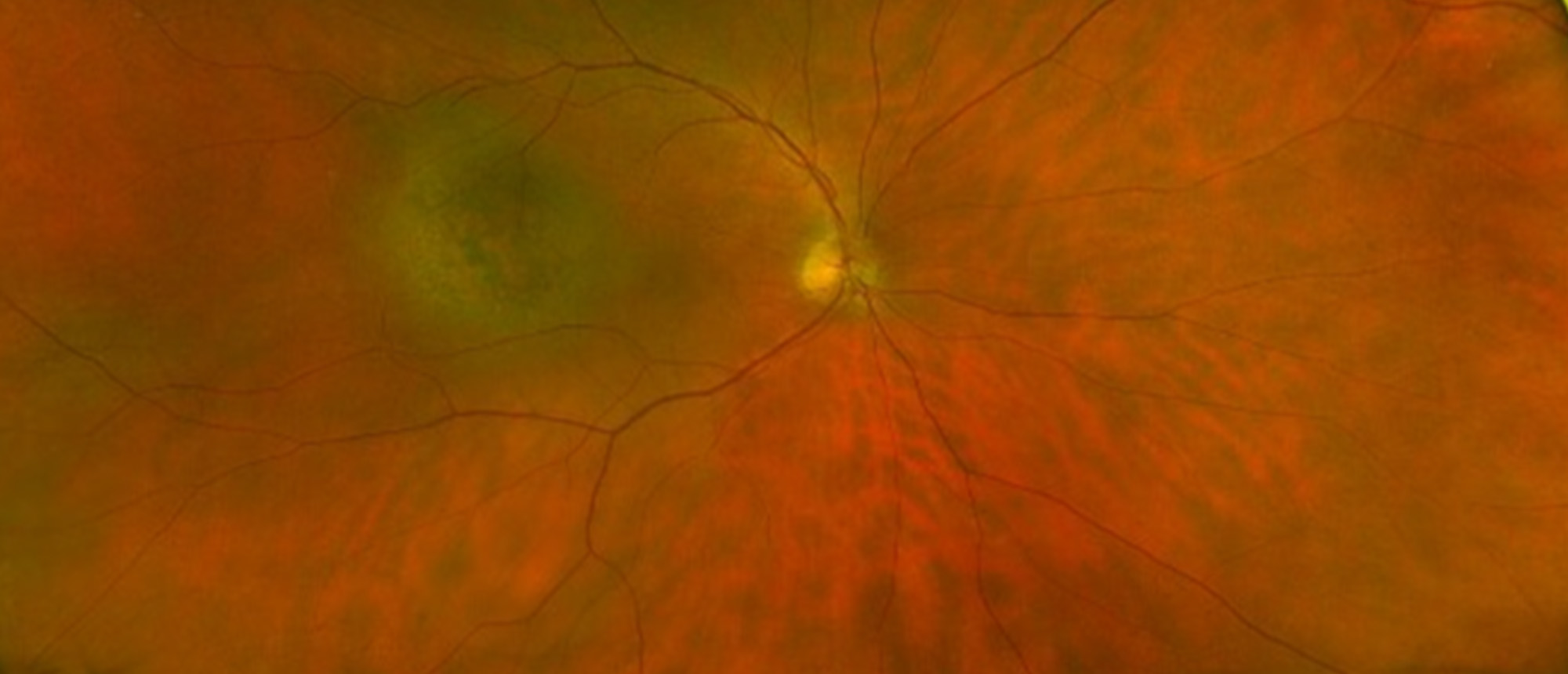 Choroidal Metastases from Advanced Cutaneous Melanoma