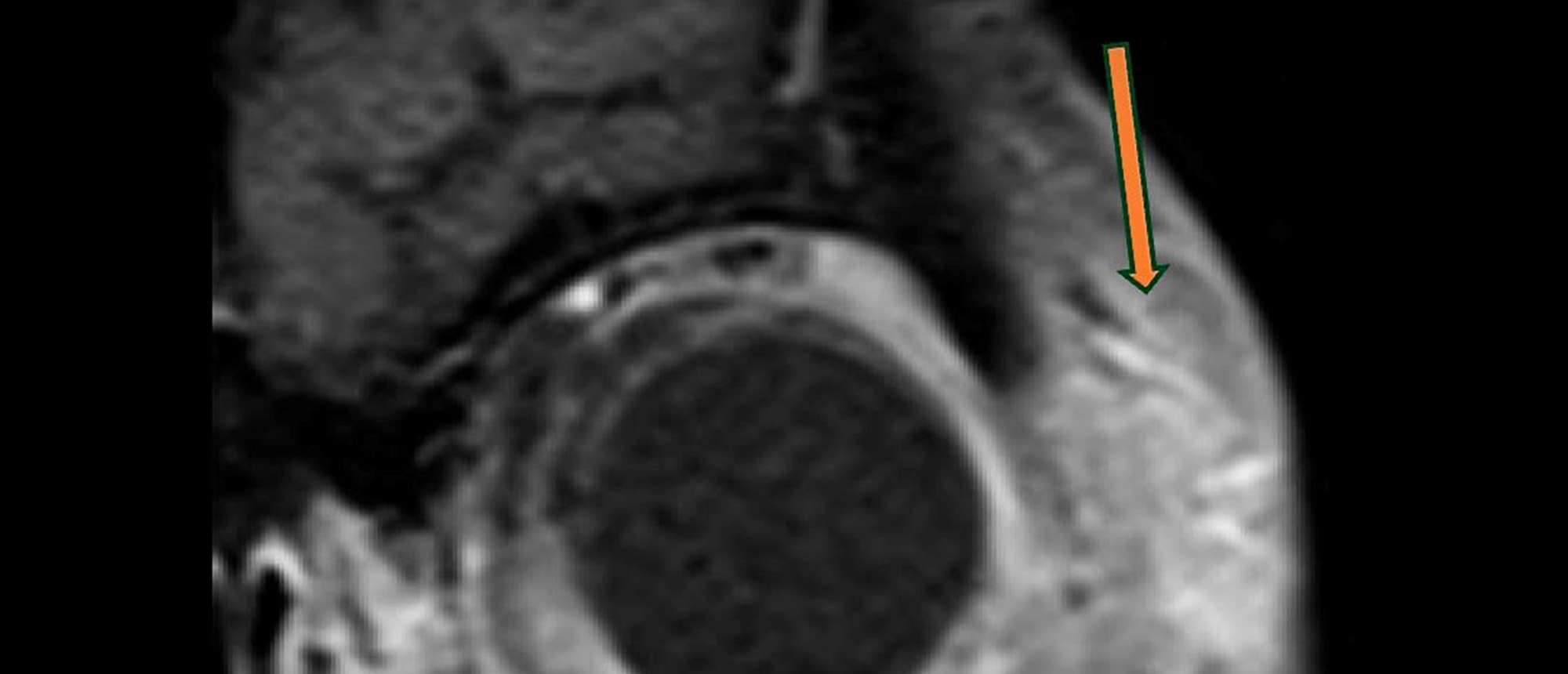 Kaposi Sarcoma of the Eyelid