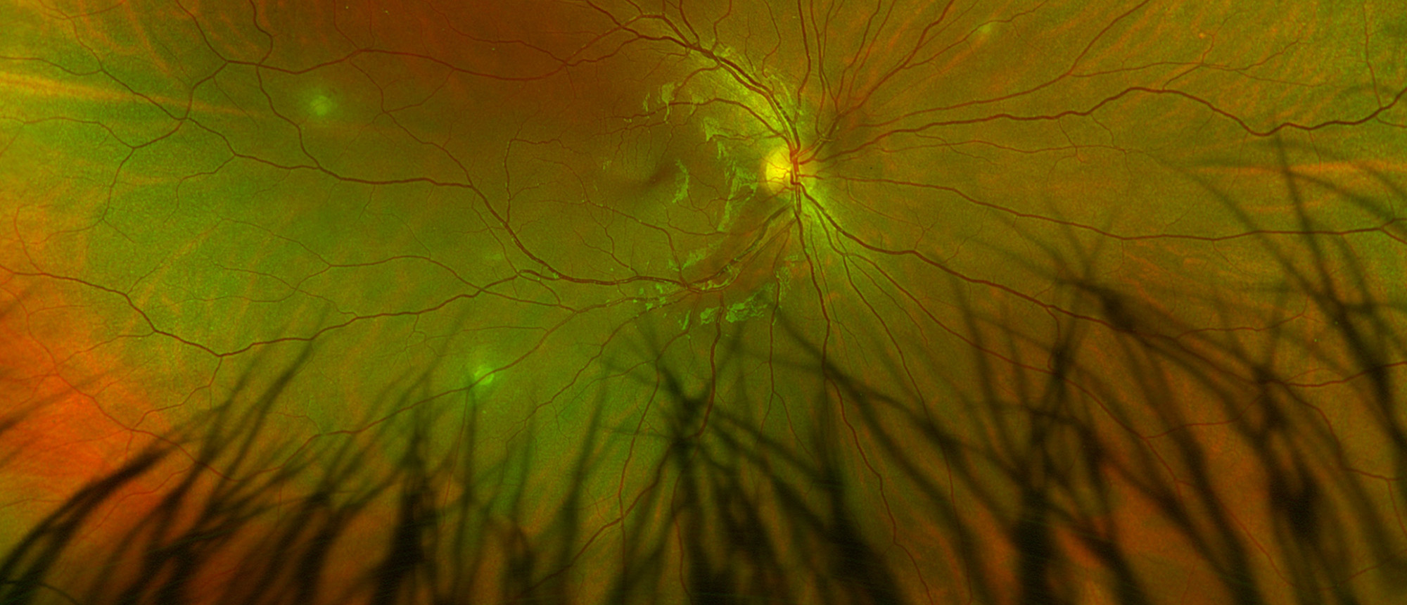 Multifocal Choroiditis from Bartonella Henselae