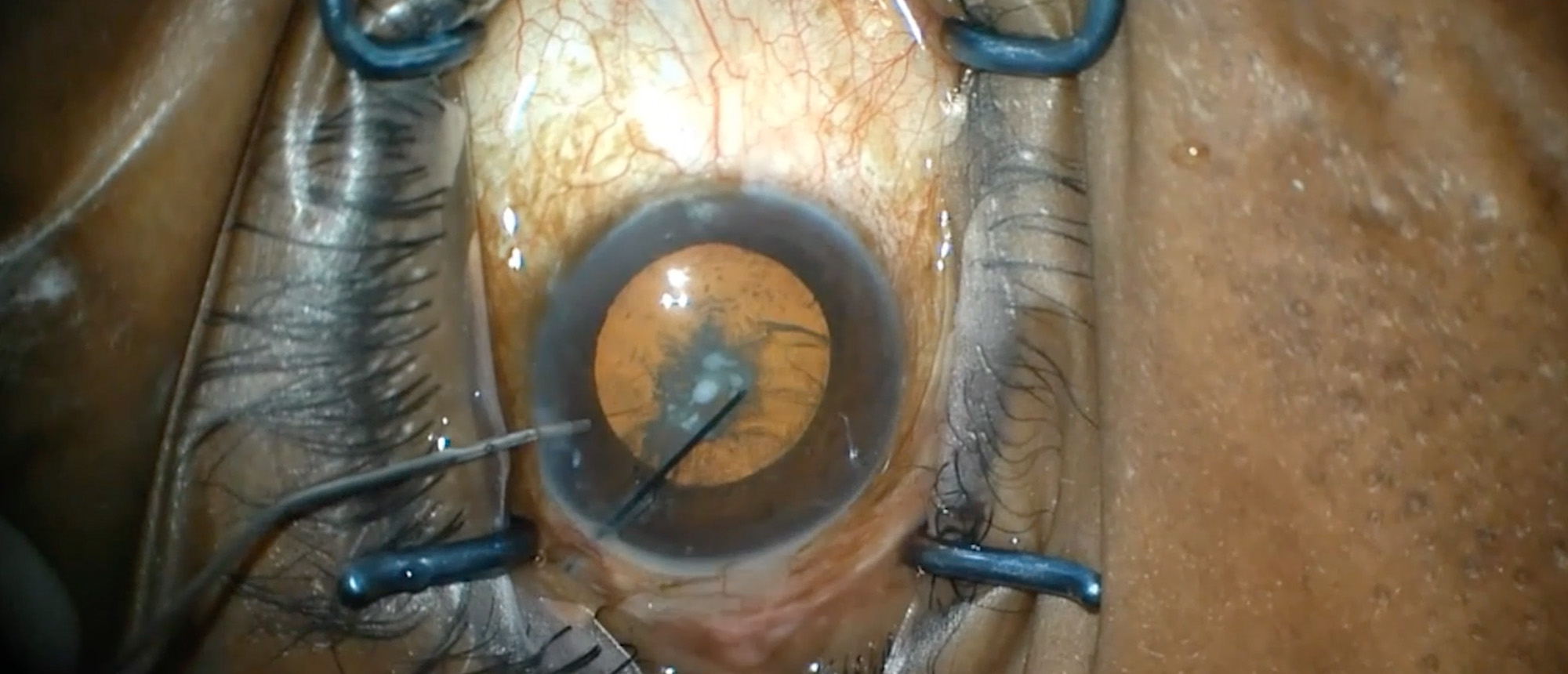 Tube Ripcord Suture Cataract