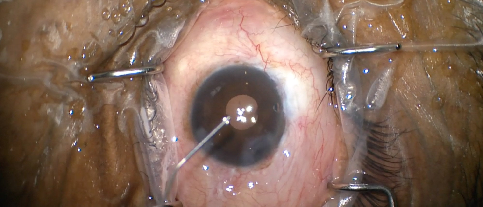 Trabeculectomy Bleb Needling