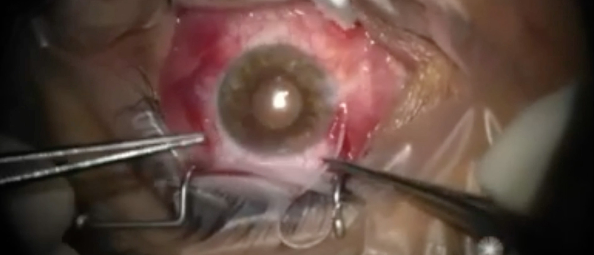 Conjunctival Excision and Extraction of Ocular Nematode