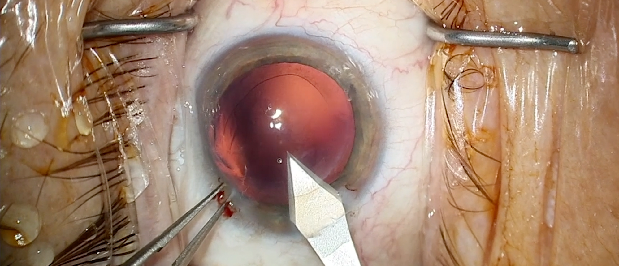IC-8 Apthera IOL Implantation