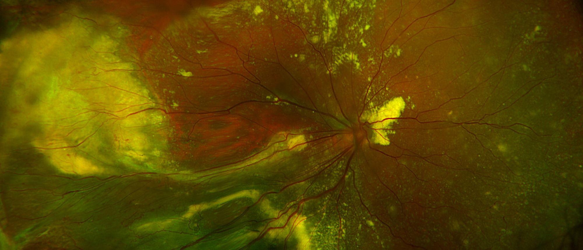 Familial Exudative Vitreoretinopathy