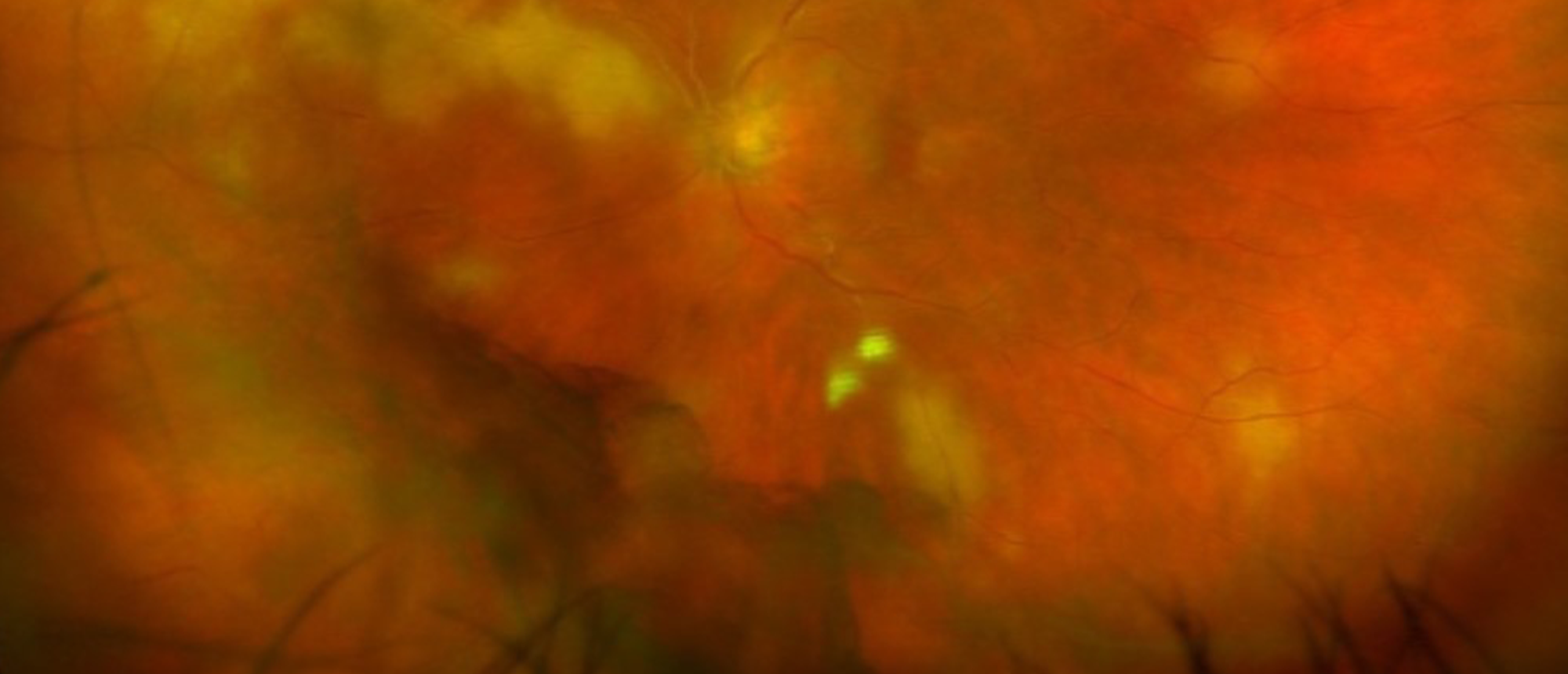 Sequential Ultrawide Field Fundus Photo, Left Eye