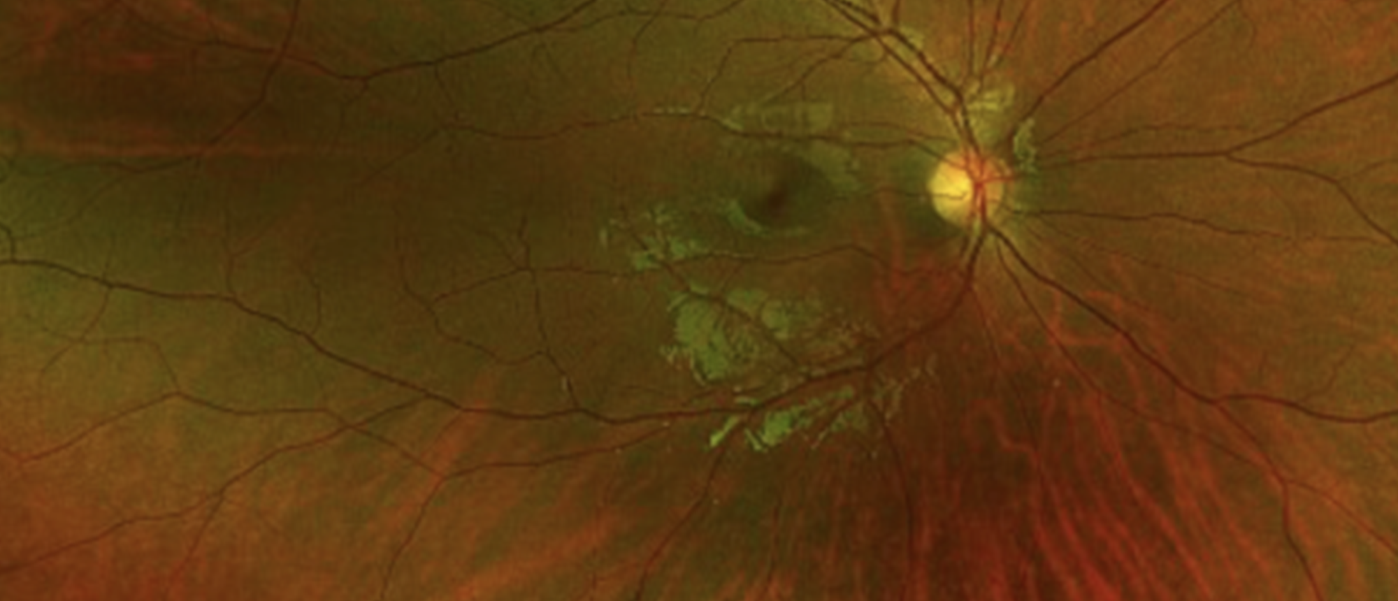 Torpedo Maculopathy (Left Eye)