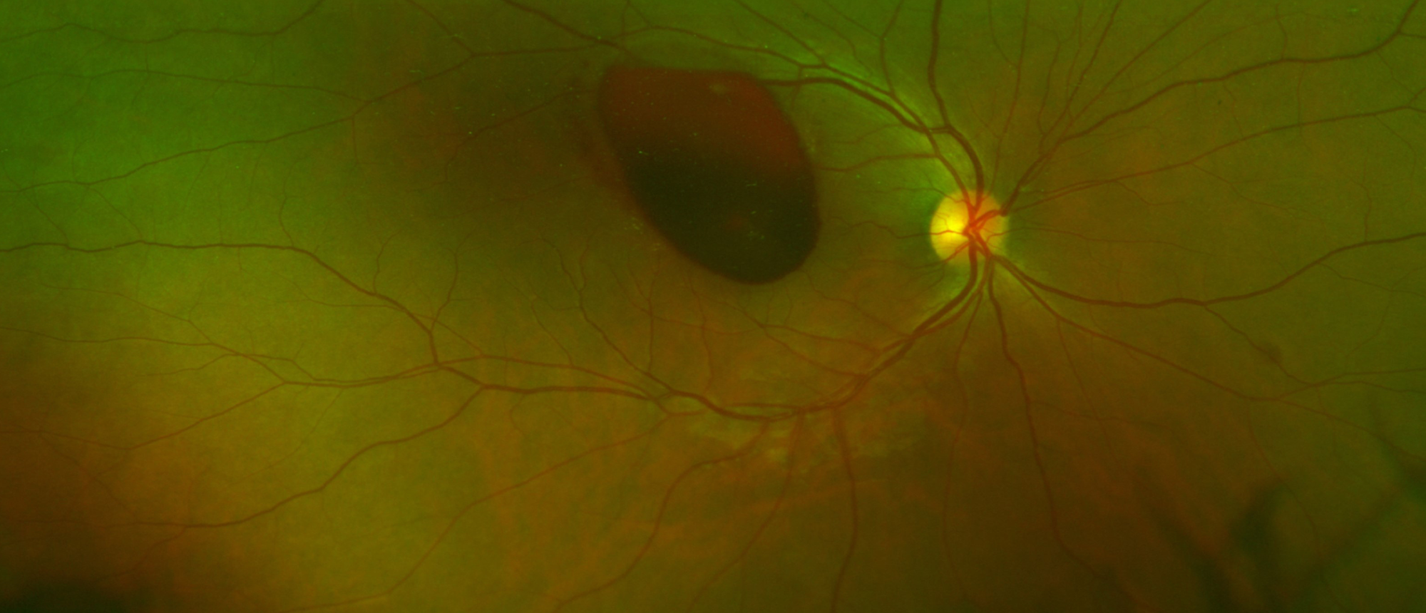 Premacular Hemorrhage Secondary to Valsalva Retinopathy
