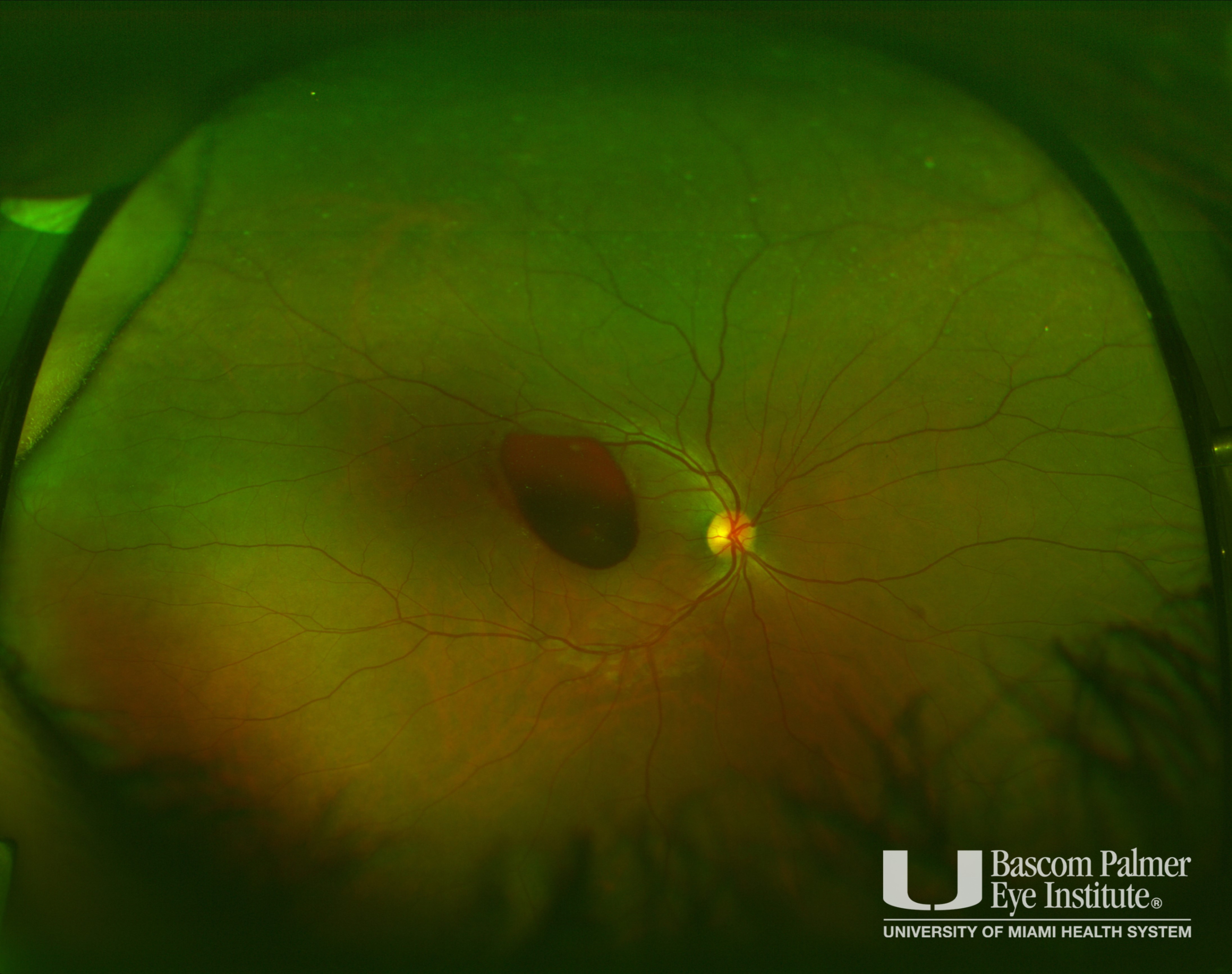 A patient with premacular hemorrhage secondary to Valsalva retinopathy