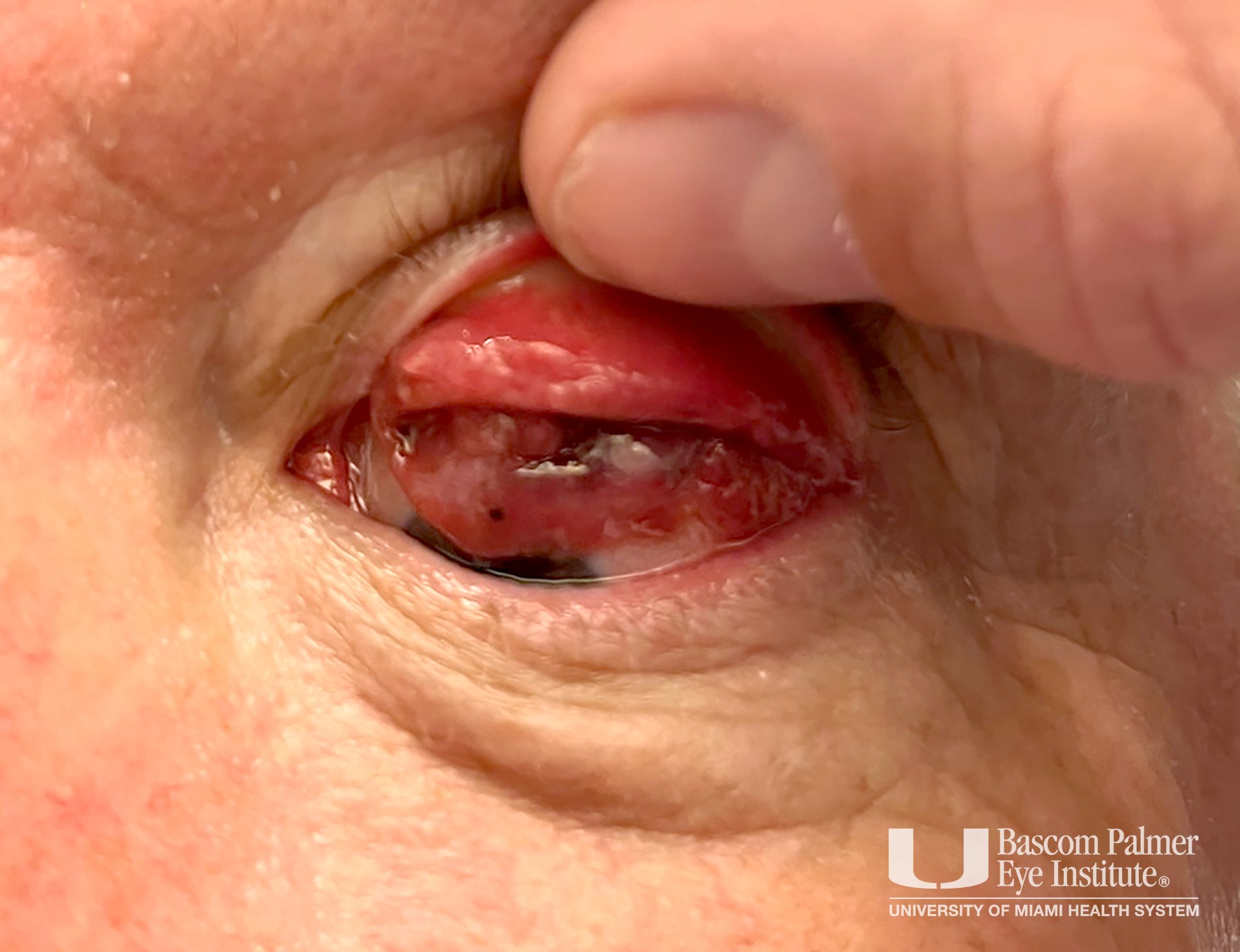 Conjunctival melanoma treated with I-125 brachytherapy